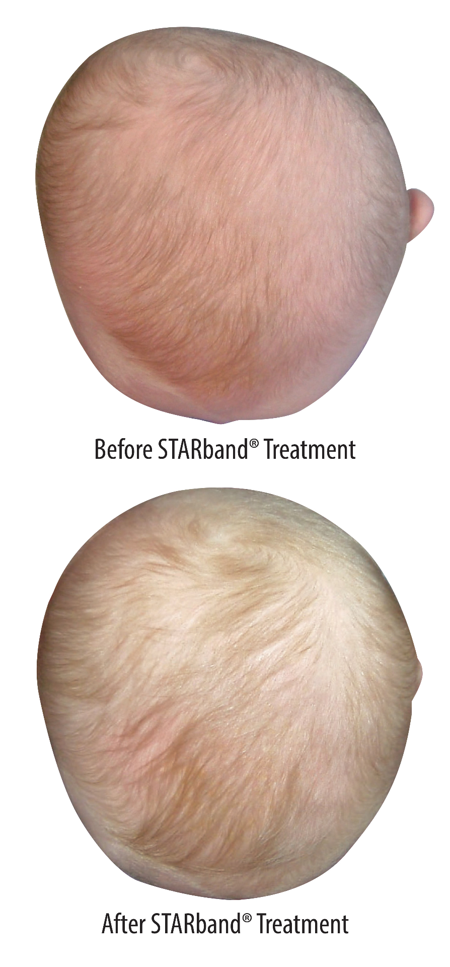 Baby's head shape before and after Starband treatment